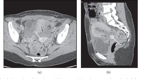 Figure 1 From Shortened Cervix In The Subsequent Pregnancy After