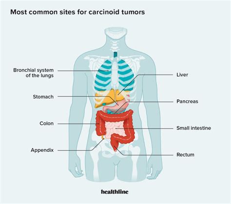Understanding Carcinoid Syndrome Ask The Nurse Expert