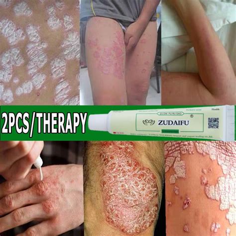 Bacteriostatic Psoriasis Cream Dermatitis Eczematoid Eczema Ointment Treatment Psoriasis Itching