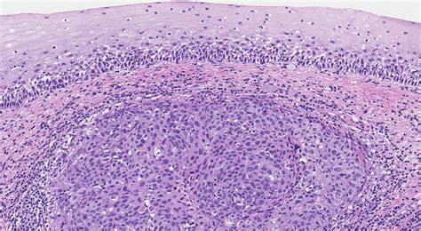 Cervical Carcinoma Histology