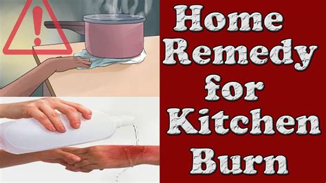 Home Remedy For Kitchen Burn How To Treat Minor Burn Preventing And Treating Burns Youtube