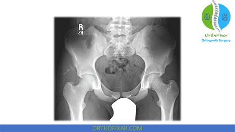 Hip Pointer Injury Orthofixar 2023