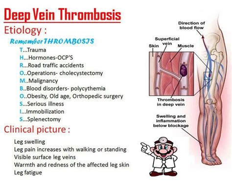 Deep Vein Thrombosis Causes And Self Help Nursing Mnemonics