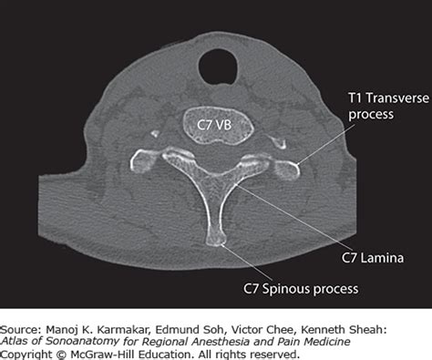 Sonoanatomy Relevant For Ultrasound Guided Injections Of The Cervical