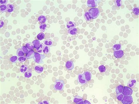 Chronic Myelogenous Leukemia Cml A Laboratory Guide To Clinical