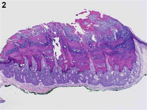 Verrucous Papules On The Scrotum Jaad Case Reports