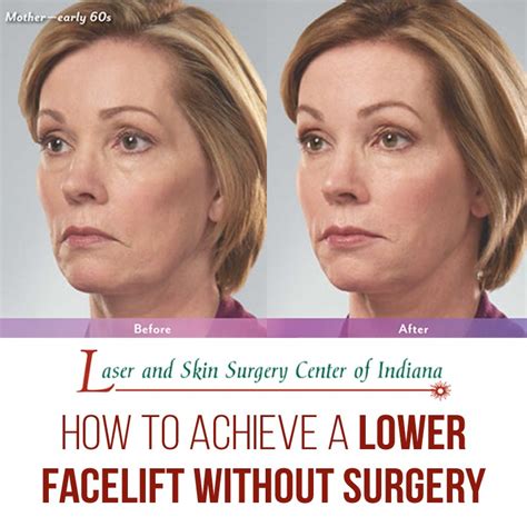 Achieve A Lower Facelift Without Surgery The Laser And Skin Surgery