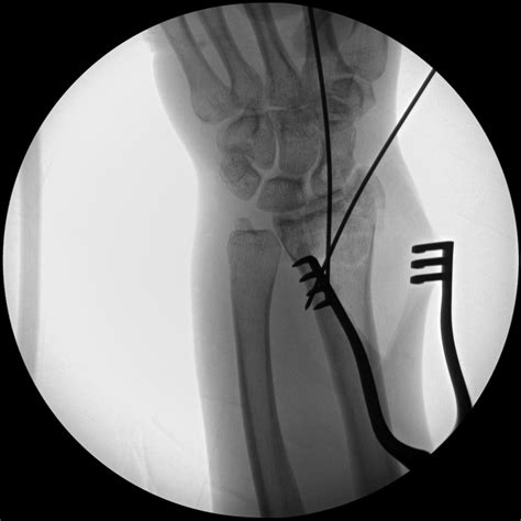 Operative Imaging For Distal Radius Fracture Volar Plate