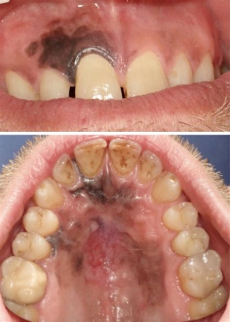 Clinical Pictures Of The Oral Pigmented Lesions At The First Oral