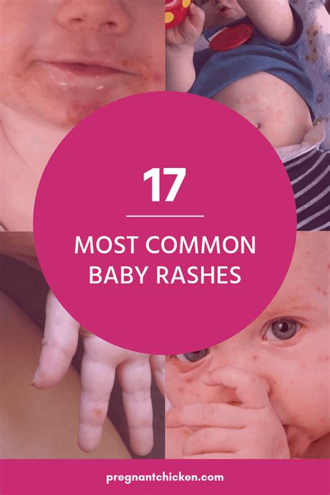 Types Of Baby Rashes Baby Rash Baby Rash Remedies Baby Rash On Face