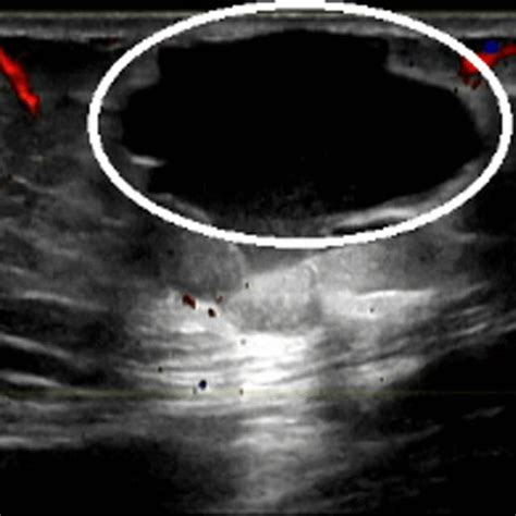 Ultrasound Image Showed Cystic Mass In Subcutaneous Fat Layer Of Right