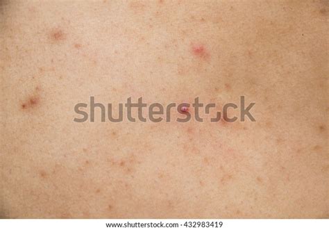 Skin Acne Scars Back Stock Photo 432983419 Shutterstock