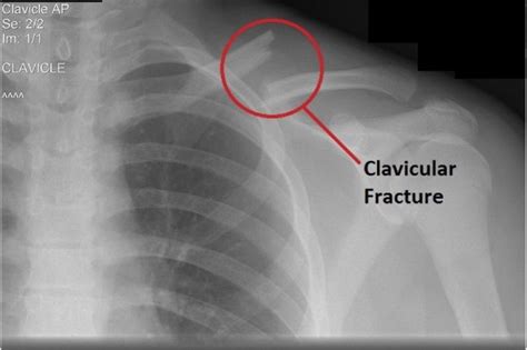 A Closer Look At Aaron Rodgers Injury Collarbone Fracture And Future