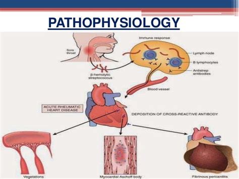 Pathophysiology Of Rheumatic Heart Disease