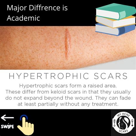 Hypertrophic Vs Keloid Scarring My Acne Scars