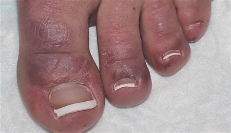 Teenager Bothered By Painful Bumps On Toes