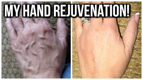 💝 How To Treat Hand Veins 💝 Youtube