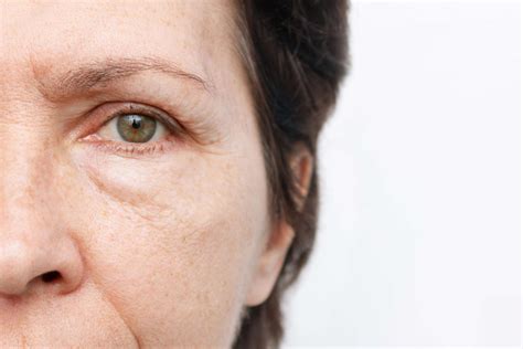 Puffy Eyes Causes And Remedies