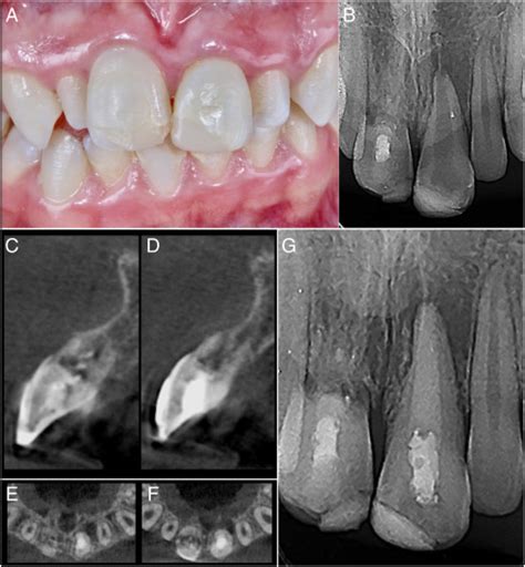 Guided Autotransplantation Of An Immature Premolar To The Maxillary
