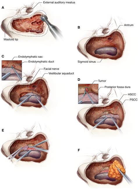Microsurgical Resection Of Endolymphatic Sac Tumors Operative