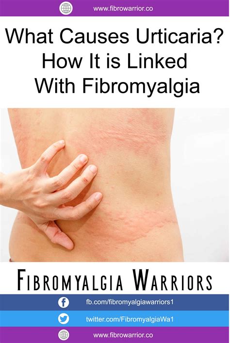 What Causes Urticaria How It Is Linked With Fibromyalgia