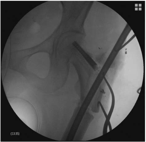 Intraoperative View Of Her Left Proximal Femur After The Lag Screw