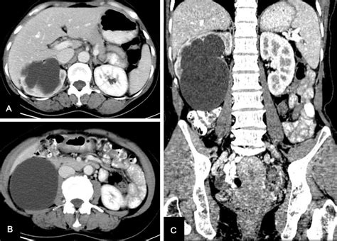 Frontiers Prolonged Postoperative Urine Leakage Due To A Calyceal Diverticulum Mimicking A