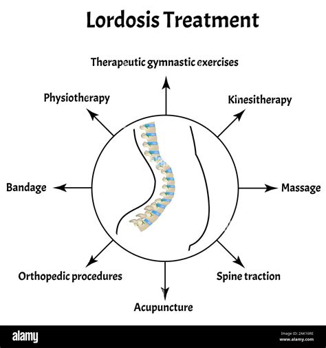 Treatment Of Lordosis Spinal Curvature Kyphosis Lordosis Scoliosis