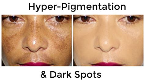 How To Remove Dark Black Patches Skin Hyper Pigmentation Dark Spots