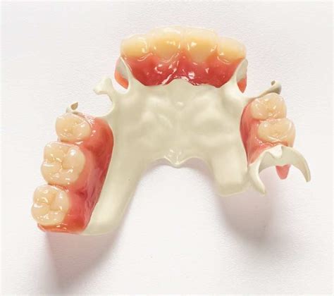 Ultaire Akp Removable Partial Denture Rpd From Solvay Dental