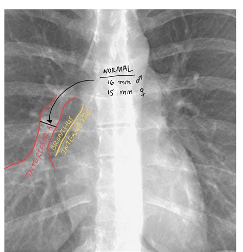 Pulmonary Artery Diameter Radiography Radiology Skull Anatomy