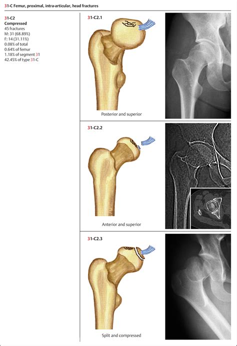 Fractures Of The Femur Musculoskeletal Key