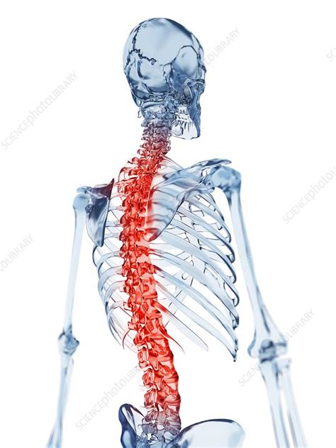 Human Back Pain Artwork Stock Image F0102127 Science Photo Library