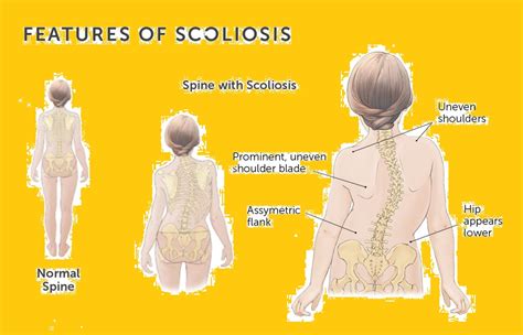 Scoliosis Types Symptoms Causes And Treatments Global Treatment