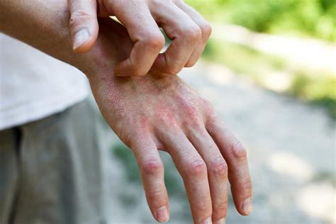 Todo lo que debes saber sobre la dermatitis atópica o eczema El Nuevo Día