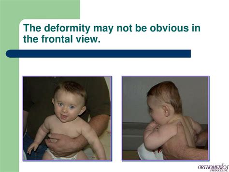Ppt The Orthotic Management Of Infants With Deformational
