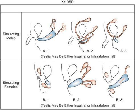 Disorders Of Sexual Development Dsd Obgyn Key