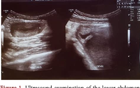 Figure From Case Report Of A Year Old Girl With Imperforate Hymenreview Of The Literature