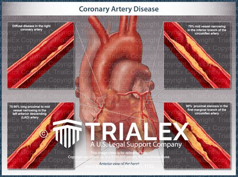 Coronary Artery Disease Trialexhibits Inc