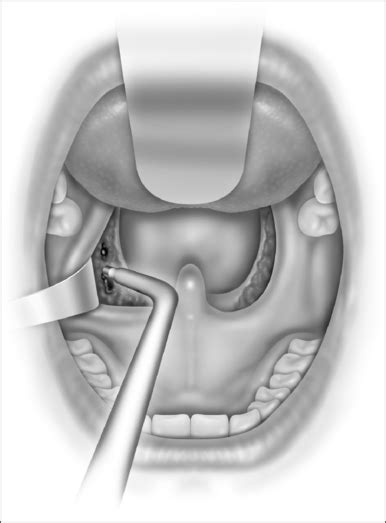 Microdebrider Assisted Tonsillectomy Pocket Dentistry