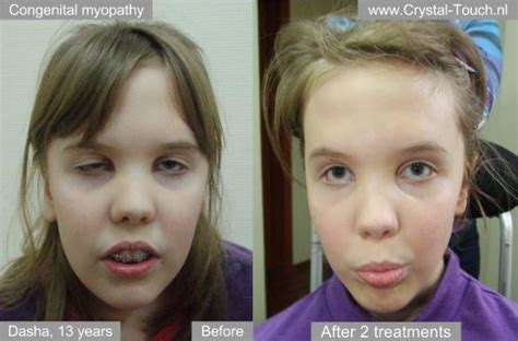 Bell's palsy is a sudden paralysis or weakness on one side of the face due to malfunction of the seventh cranial (facial) nerve that affects about 40,000 americans each year. Dasha before and after Bell's palsy treatment - Crystal ...