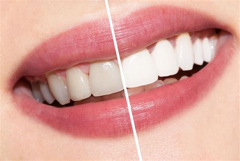 Have you ever wanted to brighten your teeth and make your smile stand out? Bright Summer Smiles: Your Guide to Whiter Teeth