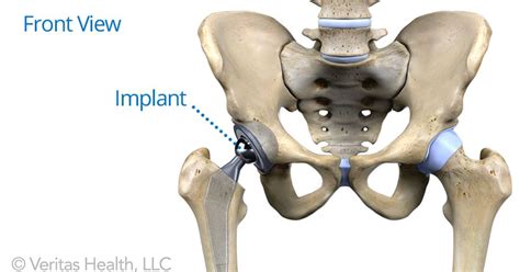 All About Anterior Hip Replacement Hip Replacement Surgery Severe