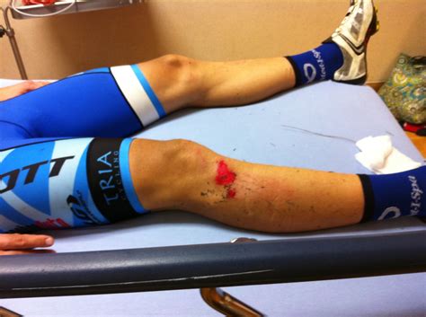 How To Treat Road Rash And Abrasions E Fitness Tips