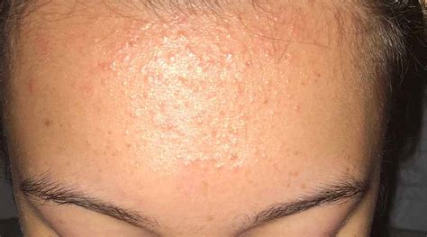 Apa Itu Fungal Acne Ini Penyebab Dan Cara Mengatasinya