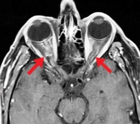 Cureus Bilateral Optic Neuritis A Rare Complication Of Mumps