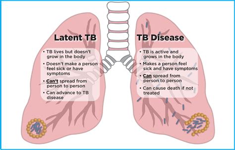 Hiv And Tuberculosis Tb Nih