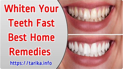 To save your time and money, we have compiled a quick list of proven home remedies for teeth whitening. Whiten Your Teeth Fast - Best Home Remedies - YouTube