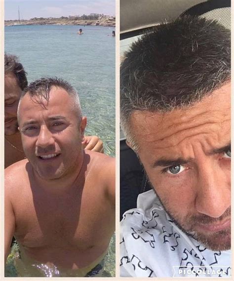 Boyalı saçlara perma uygulaması yapılabilir mi? Before & After Hair Transplantation/Saç Ekimi Öncesi ve ...