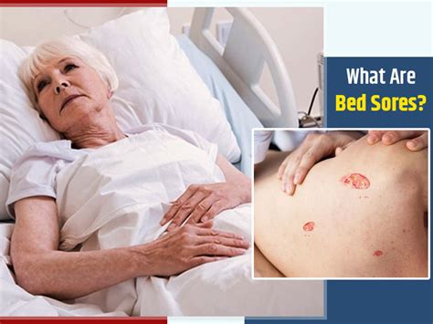 Bed Sores Know Symptoms Causes And Risk Factors For This Skin